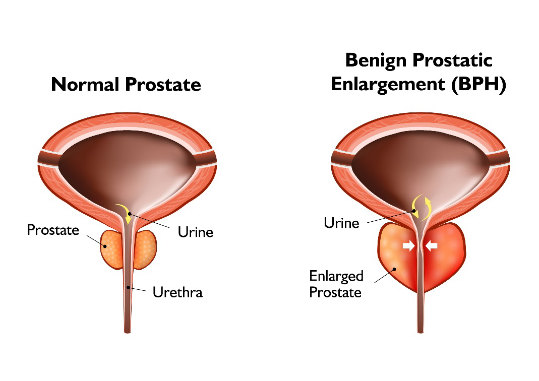 benign prostatic hyperplasia (bph) is characterized by hagyma hasznos a prosztatitisből